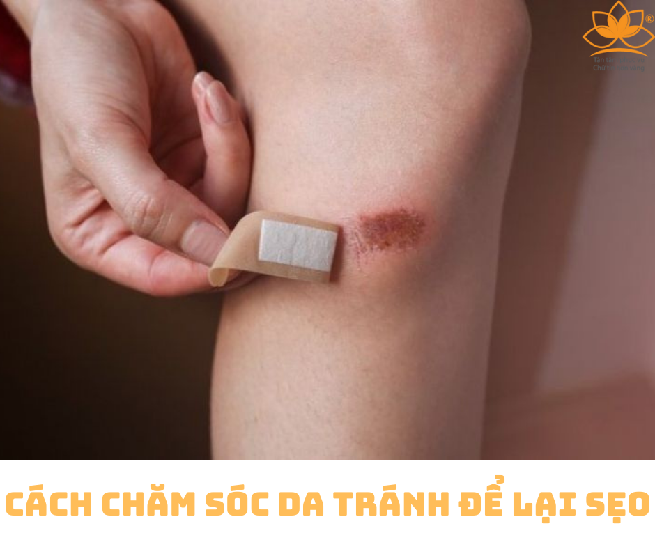 CHĂM SÓC VẾT THƯƠNG TRÁNH ĐỂ LẠI SẸO